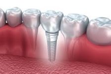 Diş implantı tedavisi ne zaman tercih edilir