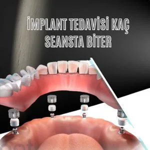 İMPLANT TEDAVİSİ KAÇ SEANSTA BİTER